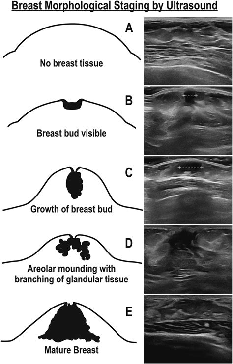 teen age girl boobs|Breast Development During Puberty: Stages and Symptoms